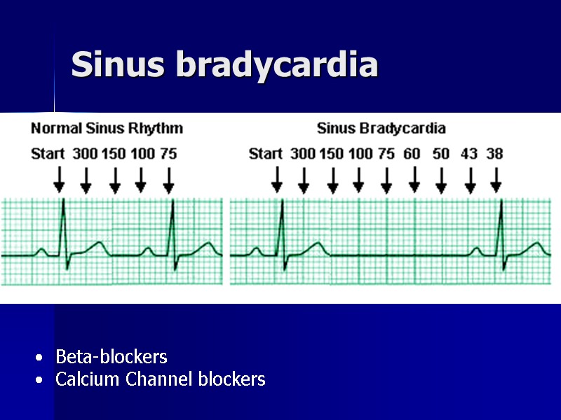 Sinus bradycardia Beta-blockers Calcium Channel blockers